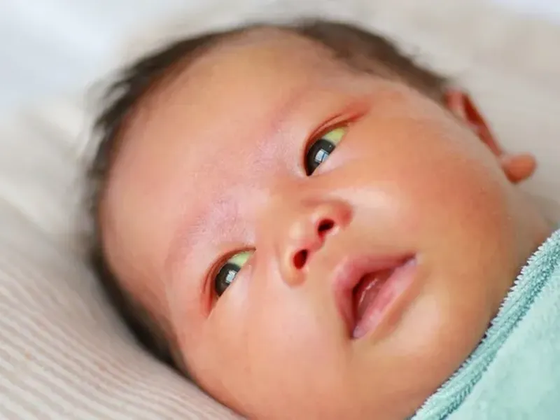 MEN GAN CAO Ở TRẺ EM: NGUYÊN NHÂN, TRIỆU CHỨNG, CÓ NGUY HIỂM KHÔNG VÀ CÁCH PHÒNG NGỪA