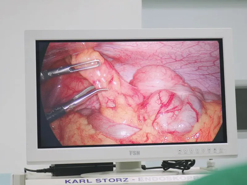 MỔ RUỘT THỪA BẰNG PHƯƠNG PHÁP NỘI SOI