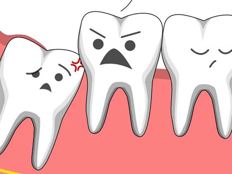 NHỮNG LÝ DO BẠN NÊN NHỔ BỎ RĂNG KHÔN