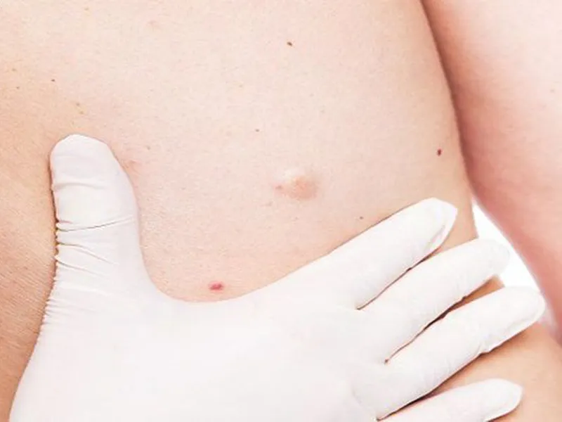 KÉN BÃ ĐẬU Ở TRẺ EM: NGUYÊN NHÂN, DẤU HIỆU NHẬN BIếT VÀ CÁCH XỬ TRÍ AN TOÀN