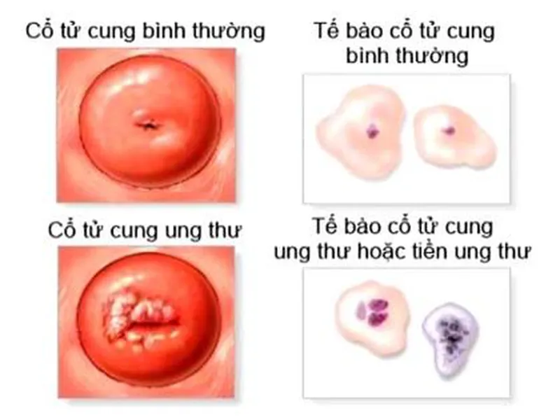 TRIỆU CHỨNG UNG THƯ CỔ TỬ CUNG