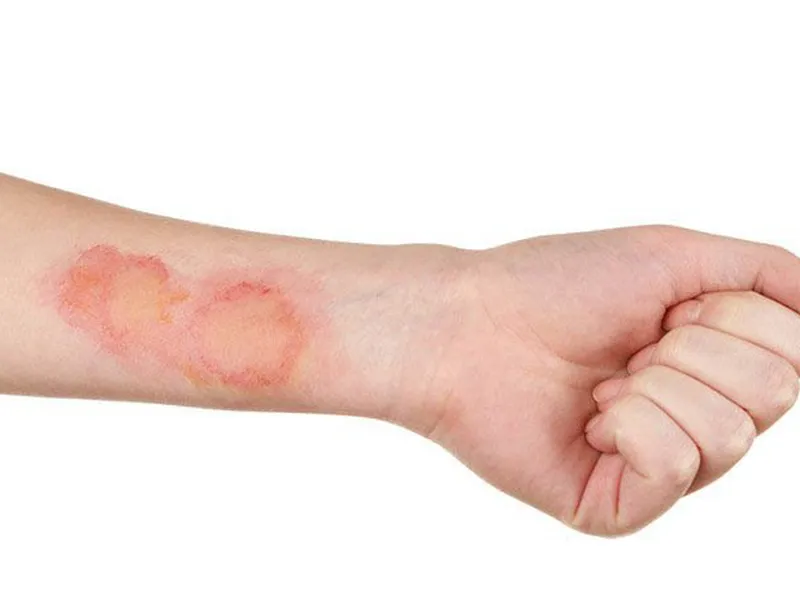 VIÊM CƠ DO NHIỄM KHUẨN LÀ GÌ? NGUYÊN NHÂN, TRIỆU CHỨNG VÀ CÁCH ĐIỀU TRỊ HIỆU QUẢ