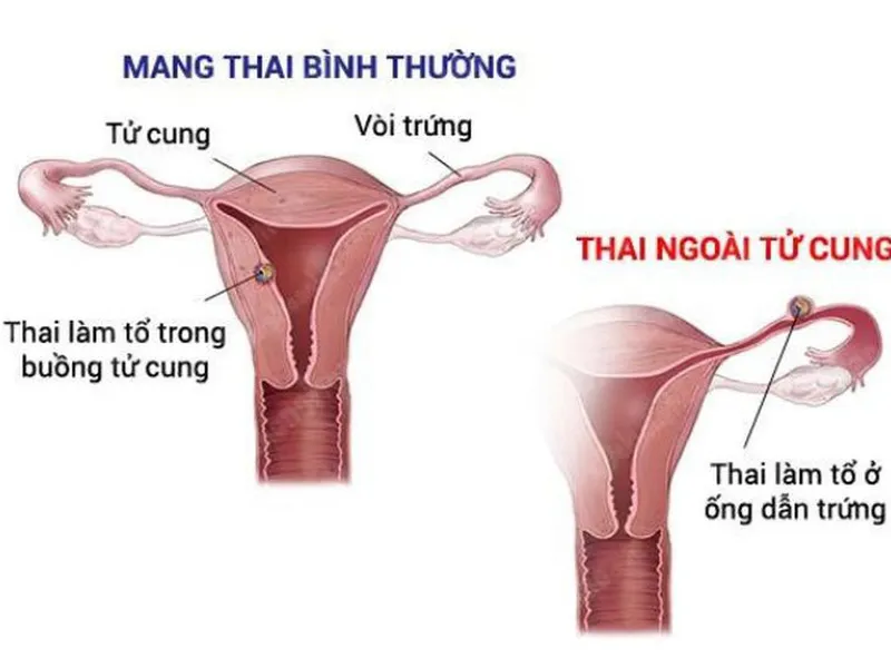 PHÁT HIỆN SỚM THAI NGOÀI TỬ CUNG