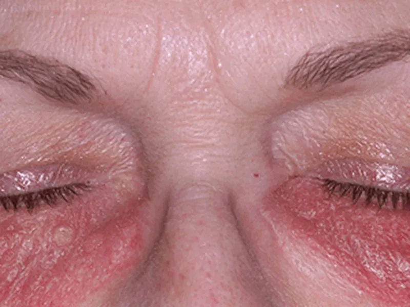 VIÊM DA TIẾP XÚC MÍ MẮT: NGUYÊN NHÂN, DẤU HIỆU VÀ CÁCH ĐIỀU TRỊ HIỆU QUẢ, NGỪA TÁI PHÁT