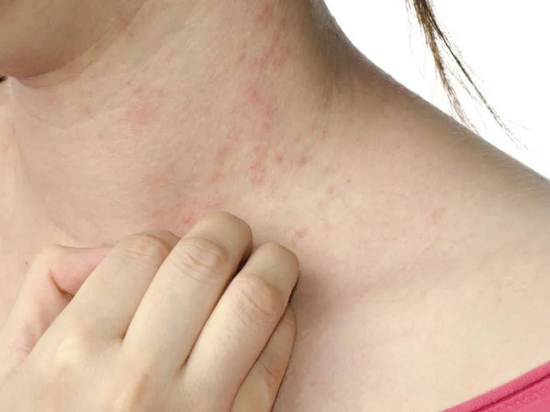 BỆNH CHÀM: DẤU HIỆU NHẬN BIẾT NGUYÊN NHÂN VÀ GIẢI PHÁP ĐIỀU TRỊ HIỆU QUẢ