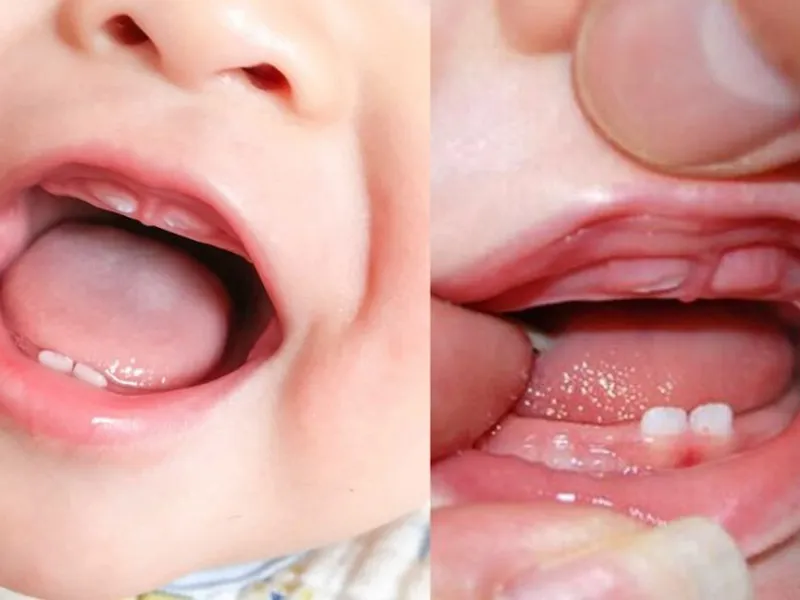 DÍNH THẮNG MÔI TRÊN Ở TRẺ LÀ GÌ? KHI NÀO CẦN CẮT VÀ CÓ ẢNH HƯỞNG GÌ KHÔNG?