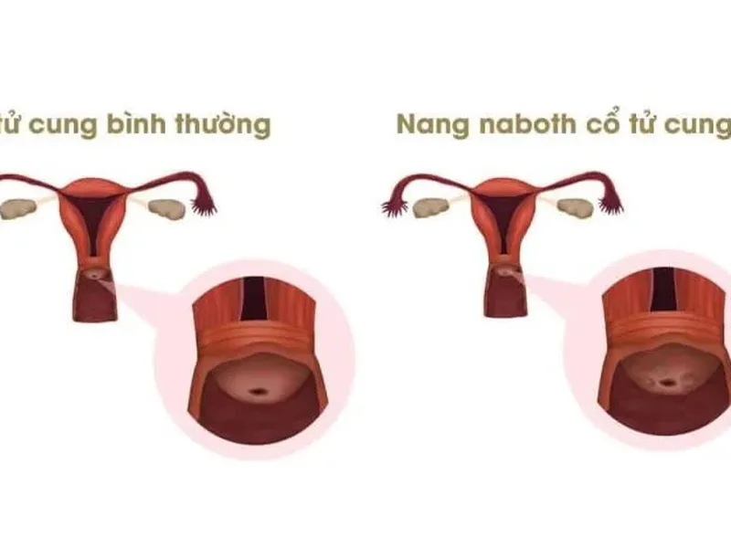 NANG NABOTH LÀ GÌ? NGUYÊN NHÂN GÂY BỆNH, TRIỆU CHỨNG VÀ PHÒNG NGỪA BỆNH
