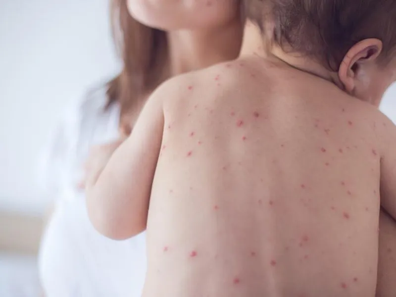 VIÊM NÃO DO SỞI – BIẾN CHỨNG NGUY HIỂM CẦN PHÒNG NGỪA