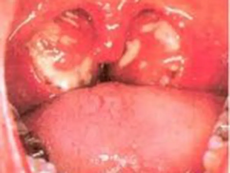 NHỮNG ĐIỀU CẦN BIẾT KHI PHẪU THUẬT AMIDAN ???