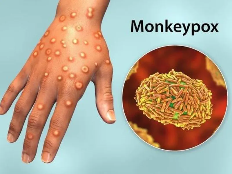 BỆNH ĐẬU MÙA KHỈ: TRIỆU CHỨNG, BIẾN CHỨNG VÀ PHƯƠNG PHÁP PHÒNG NGỪA HIỆU QUẢ