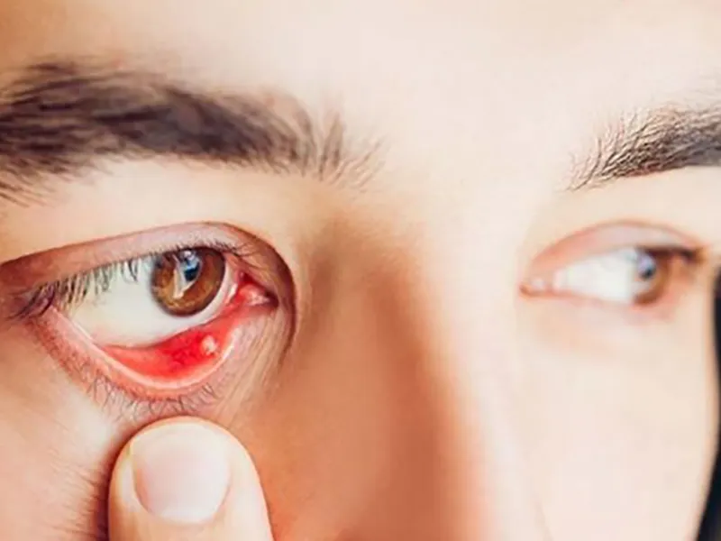 ĐAU MẮT HỘT LÀ GÌ? NGUYÊN NHÂN, TRIỆU CHỨNG, CÁCH LÂY VÀ PHƯƠNG PHÁP ĐIỀU TRỊ HIỆU QUẢ