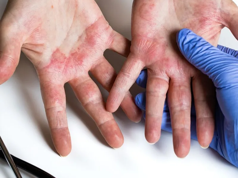 VIÊM DA TIẾP XÚC Ở TRẺ EM: NGUYÊN NHÂN, DẤU HIỆU, CÁCH ĐIỀU TRỊ VÀ PHÒNG NGỪA