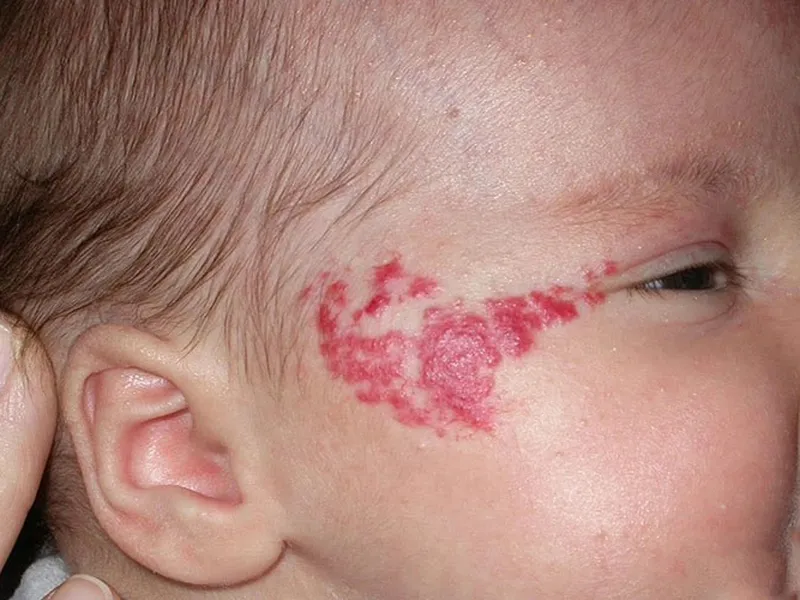 U MÁU Ở TRẺ LÀ GÌ? NGUYÊN NHÂN VÀ TRIỆU CHỨNG CỦA BỆNH U MÁU