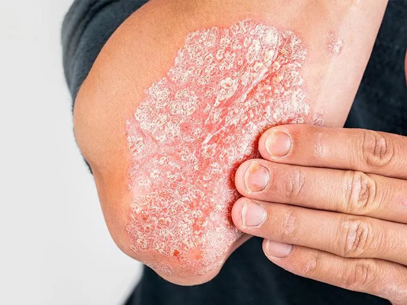 BỆNH VẢY NẾN: DẤU HIỆU NHẬN BIẾT, BIẾN CHỨNG NGUY HIỂM VÀ PHƯƠNG PHÁP ĐIỀU TRỊ