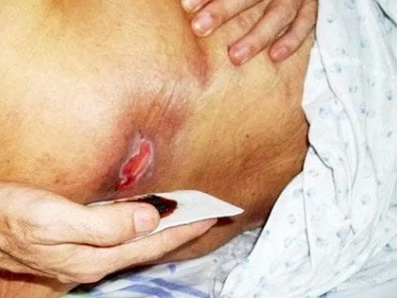 LOÉT DA Ở NGƯỜI CAO TUỔI