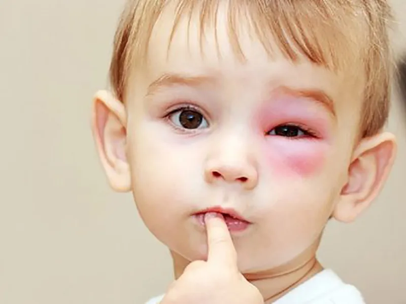 ĐAU MẮT ĐỎ Ở TRẺ EM: NGUYÊN NHÂN, TRIỆU CHỨNG, CÁCH ĐIỀU TRỊ VÀ PHÒNG NGỪA
