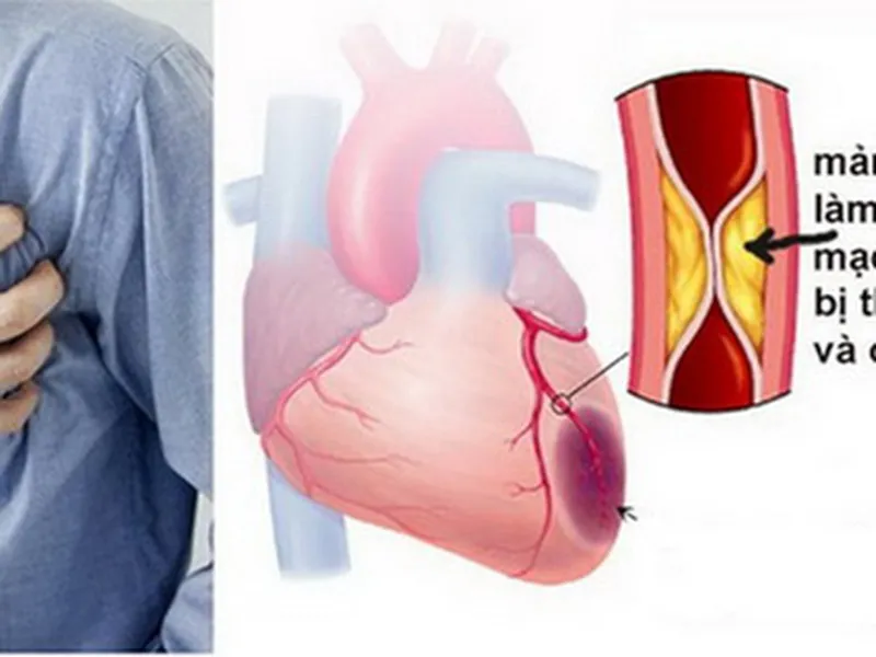 ĐIỀU TRỊ BỆNH LÝ XƠ VỮA MẠCH MÁU