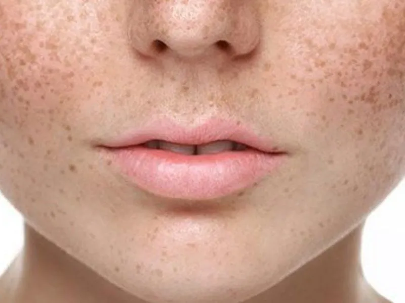 NỔI ĐỒI MỒI TRONG THAI KỲ CÓ NGUY HIỂM KHÔNG? HƯỚNG DẪN CHĂM SÓC ĐÚNG CÁCH