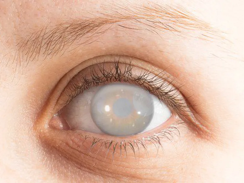 NGUYÊN NHÂN VÀ TRIỆU CHỨNG BỆNH ĐỤC THỦY TINH THỂ