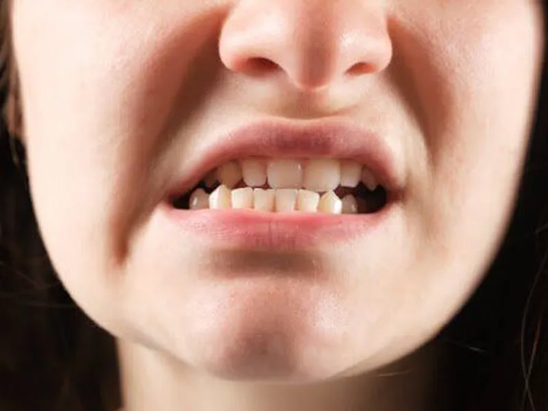 SAI KHỚP CẮN LÀ GÌ? NGUYÊN NHÂN, DẤU HIỆU, TÁC HẠI VÀ CÁCH ĐIỀU TRỊ HIỆU QUẢ