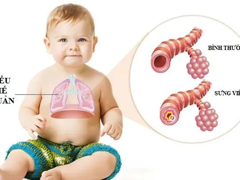 VIÊM PHẾ QUẢN CẤP Ở TRẺ CÓ NGUY HIỂM KHÔNG? BIẾN CHỨNG VÀ CÁCH NHẬN BIẾT