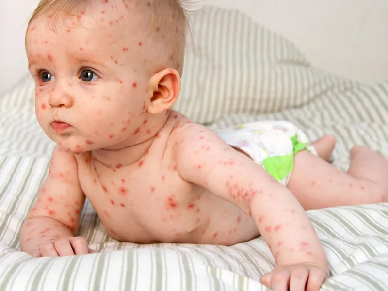 SỐT VIRUS Ở TRẺ SƠ SINH: DẤU HIỆU NHẬN BIẾT, NGUYÊN NHÂN VÀ CÁCH PHÒNG NGỪA HIỆU QUẢ