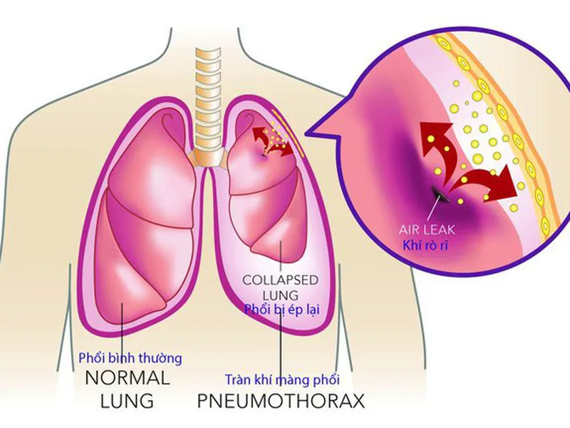TRÀN DỊCH MÀNG PHỔI: NGUYÊN NHÂN, TRIỆU CHỨNG VÀ CÁCH ĐIỀU TRỊ HIỆU QUẢ