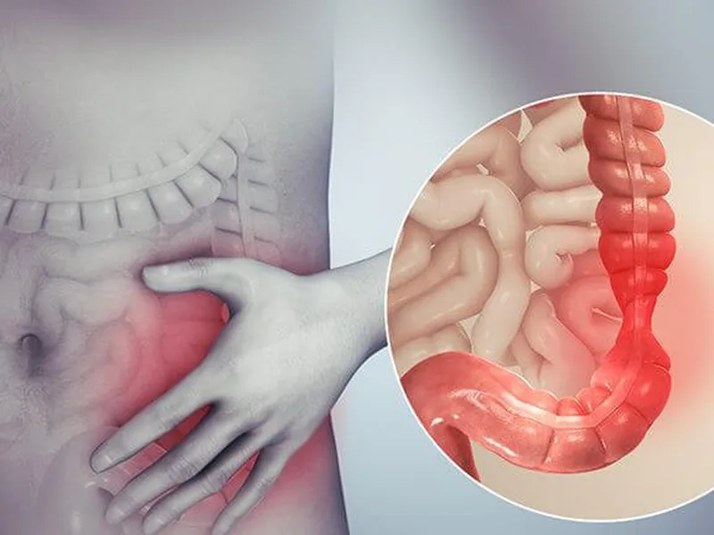 VIÊM ĐẠI TRÀNG CO THẮT: NGUY CƠ, TRIỆU CHỨNG VÀ CÁCH ĐIỀU TRỊ HIỆU QUẢ