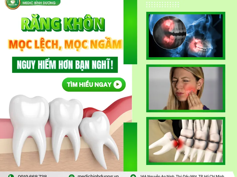 RĂNG KHÔN MỌC NGẦM: NGUYÊN NHÂN, TRIỆU CHỨNG, BIẾN CHỨNG VÀ CÁCH ĐIỀU TRỊ