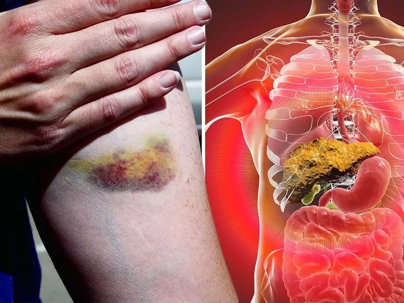 GAN NHIỄM ĐỘC CÓ NGUY HIỂM KHÔNG? NGUYÊN NHÂN VÀ DÂU HIỆU NHẬN BIẾT LÀ GÌ?