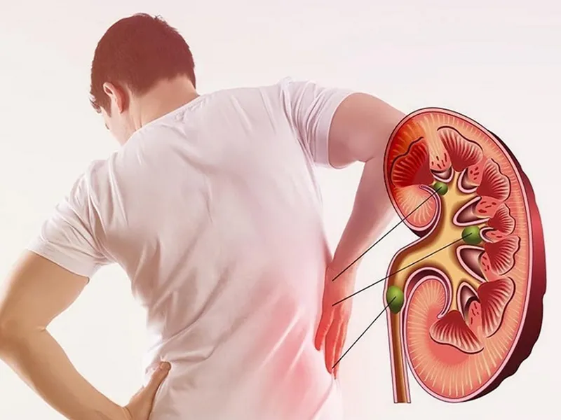 SUY THẬN MÃN TÍNH LÀ GÌ? DẤU HIỆU NHẬN BIẾT, NGUYÊN NHÂN VÀ CÁCH NGĂN NGỪA SỚM