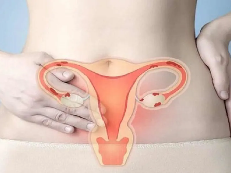 PHÒNG NGỪA UNG THƯ CỔ TỬ CUNG.