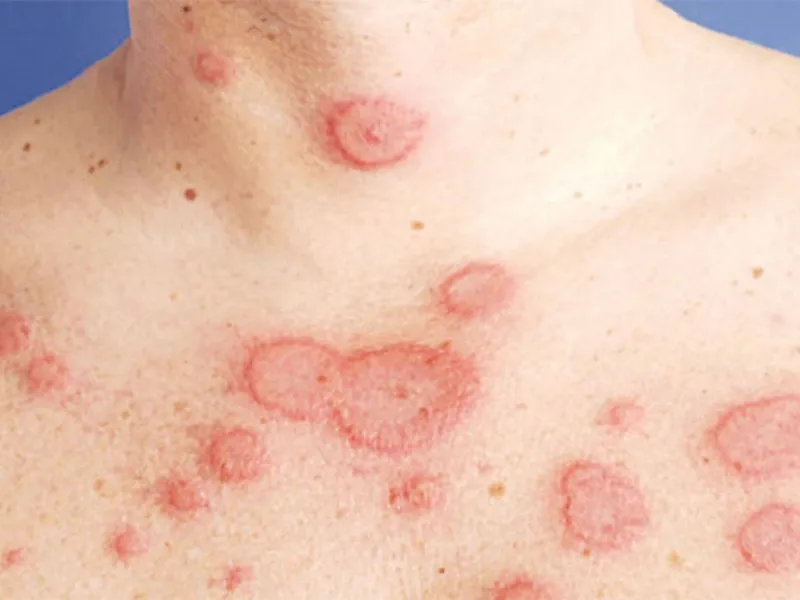 LUPUS BAN ĐỎ HỆ THỐNG LÀ GÌ? NGUYÊN NHÂN, TRIỆU CHỨNG VÀ BIẾN CHỨNG NGUY HIỂM
