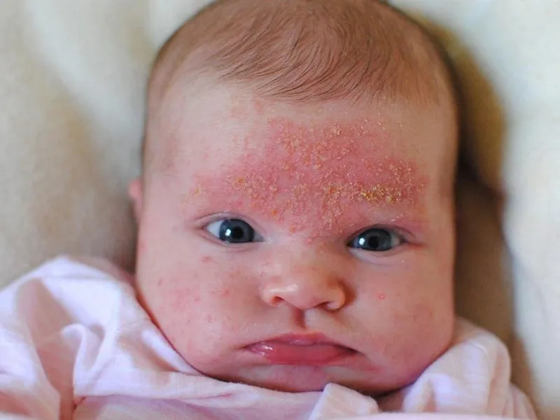 TRẺ BỊ GIỜI LEO: NGUYÊN NHÂN, DẤU HIỆU VÀ CÁCH PHÒNG NGỪA