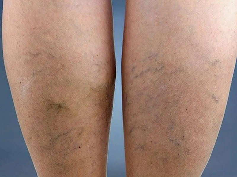 SUY TĨNH MẠCH NGOẠI BIÊN LÀ GÌ? CÁCH NHẬN BIẾT VÀ ĐIỀU TRỊ KỊP THỜI