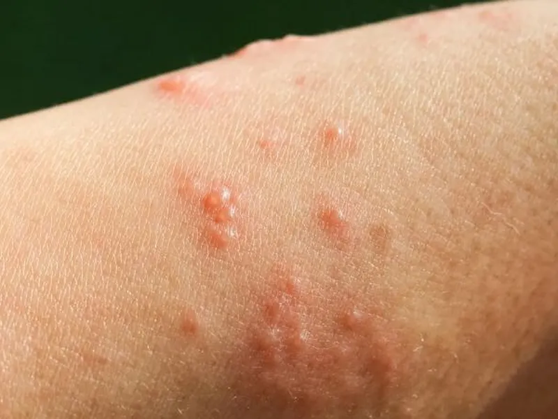 GHẺ NƯỚC LÀ GÌ? CÁCH NHẬN BIẾT, ĐIỀU TRỊ VÀ NGĂN NGỪA LÂY LAN