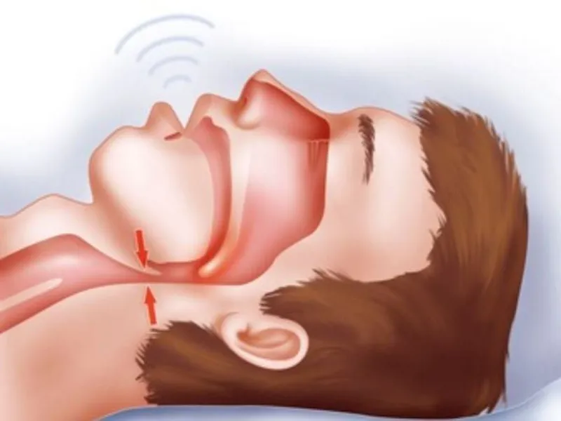NGƯNG THỞ KHI NGỦ: NGUYÊN NHÂN, TRIỆU CHỨNG, CÁCH CHẨN ĐOÁN VÀ ĐIỀU TRỊ