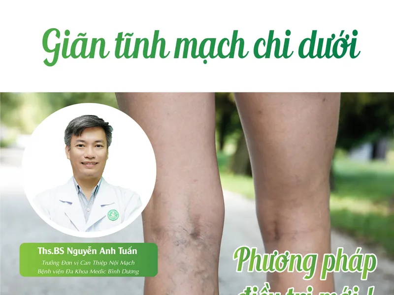 GIÃN TĨNH MẠCH CHI DƯỚI: PHƯƠNG PHÁP ĐIỀU TRỊ MỚI