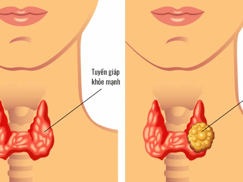 SUY GIÁP LÀ GÌ? NGUYÊN NHÂN, TRIỆU CHỨNG VÀ CÁCH ĐIỀU TRỊ HIỆU QUẢ