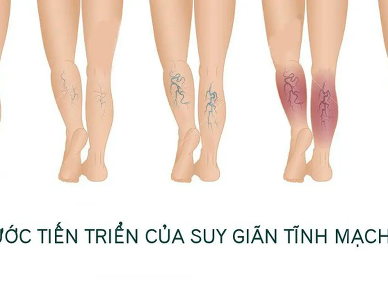 SUY GIÃN TĨNH MẠCH CHÂN: TRIỆU CHỨNG, NGUYÊN NHÂN VÀ CÁCH PHÒNG NGỪA HIỆU QUẢ