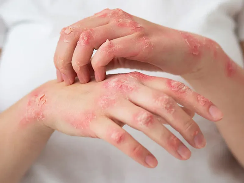 VIÊM DA CƠ ĐỊA KHI GIAO MÙA: NGUYÊN NHÂN, TRIỆU CHỨNG VÀ CÁCH PHÒNG NGỪA HIỆU QUẢ