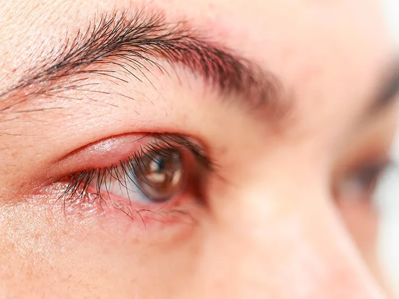 VIÊM KẾT MẠC DỊ ỨNG LÀ GÌ? TRIỆU CHỨNG VÀ BIỆN PHÁP ĐIỀU TRỊ