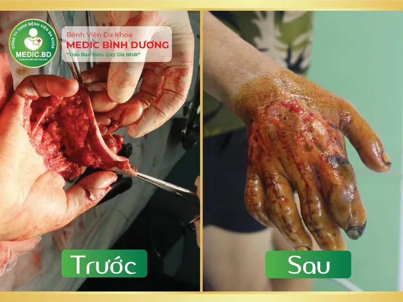 PHẪU THUẬT CHỈNH HÌNH BÀN TAY DO TAI NẠN