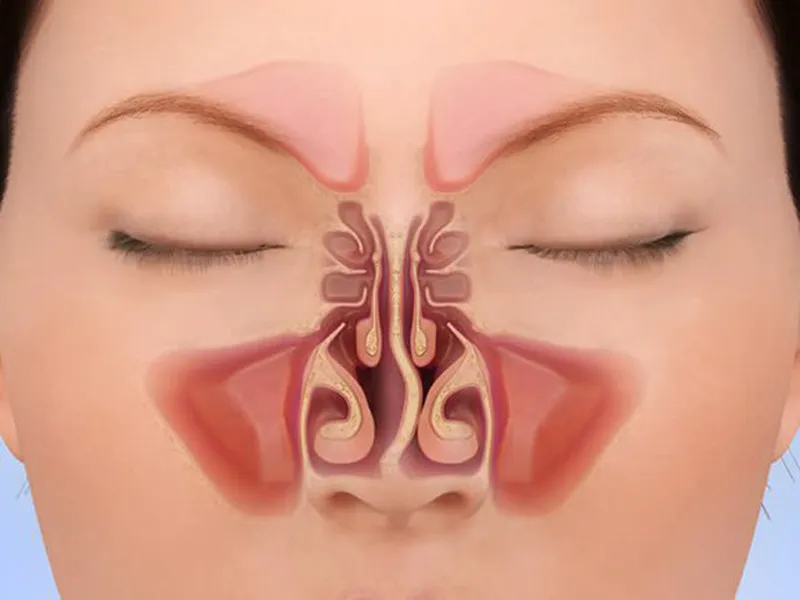 VẸO VÁCH NGĂN MŨI CẦN MỔ KHI NÀO?