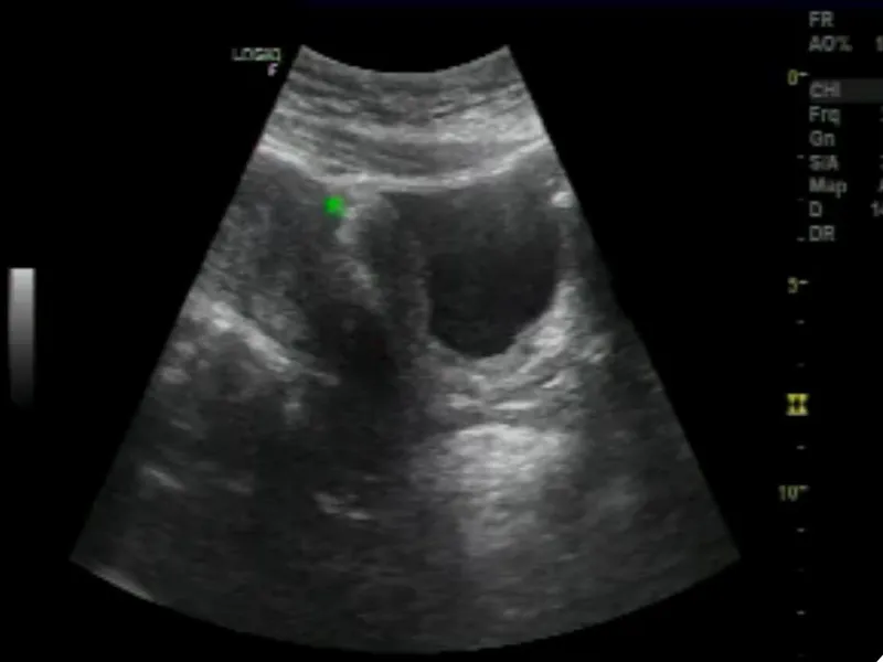 LẠC NỘI MẠC TỬ CUNG Ở THÀNH SAU BÀNG QUANG