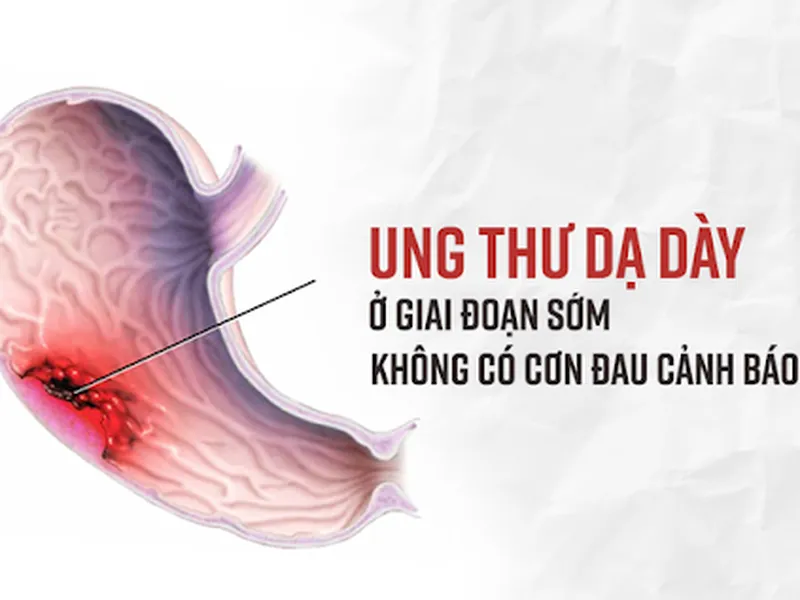 PHÁT HIỆN SỚM UNG THƯ DẠ DÀY Ở GIAI ĐOẠN ĐẦU