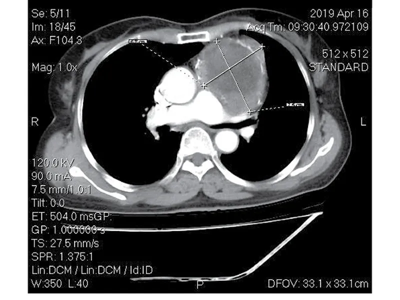CHẨN ĐOÁN HÌNH ẢNH PHÁT HIỆN U QUÁI TRUNG THẤT