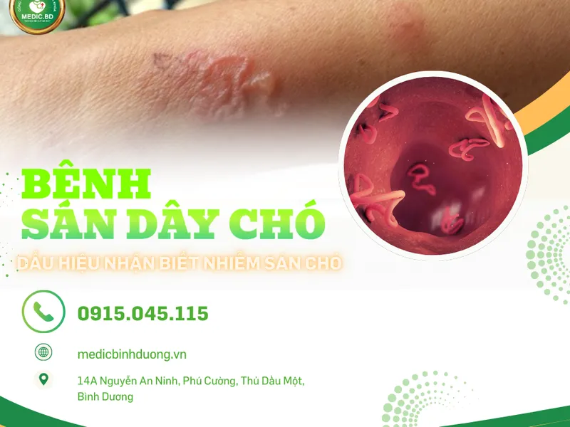SÁN CHÓ LÀ GÌ? DẤU HIỆU, NGUYÊN NHÂN VÀ CÁCH ĐIỀU TRỊ