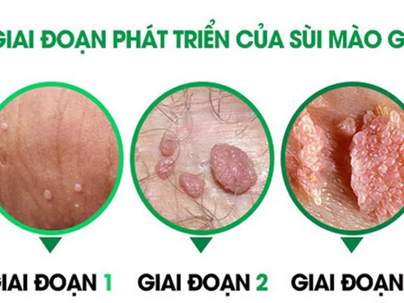 SÙI MÀO GÀ BỆNH LIÊN QUAN ĐẾN UNG THƯ SINH DỤC NỮ