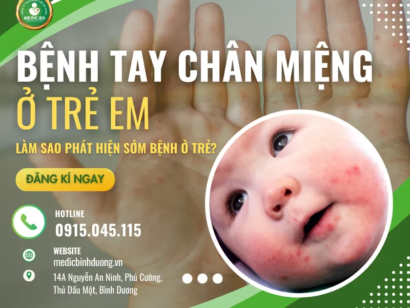 TAY CHÂN MIỆNG Ở TRẺ EM: DẤU HIỆU, ĐIỀU TRỊ VÀ PHÒNG NGỪA